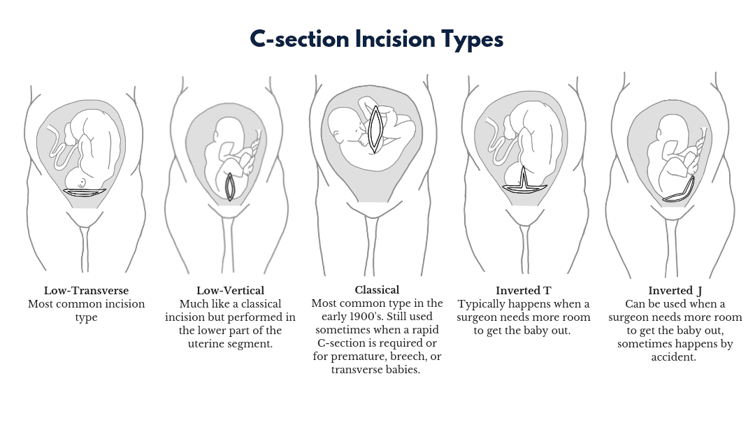 C-section Incision Types